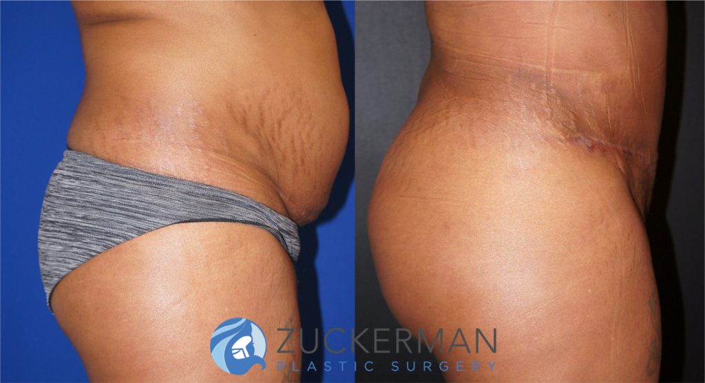 Buttock augmentation, or Brazilian Butt Lift (BBL), by Dr. Zuckerman. Patient, female, 3 months postop. 3 liters of fat removed from abdomen, flanks, and lower back. 1100cc of fat grafted to each buttock. right profile