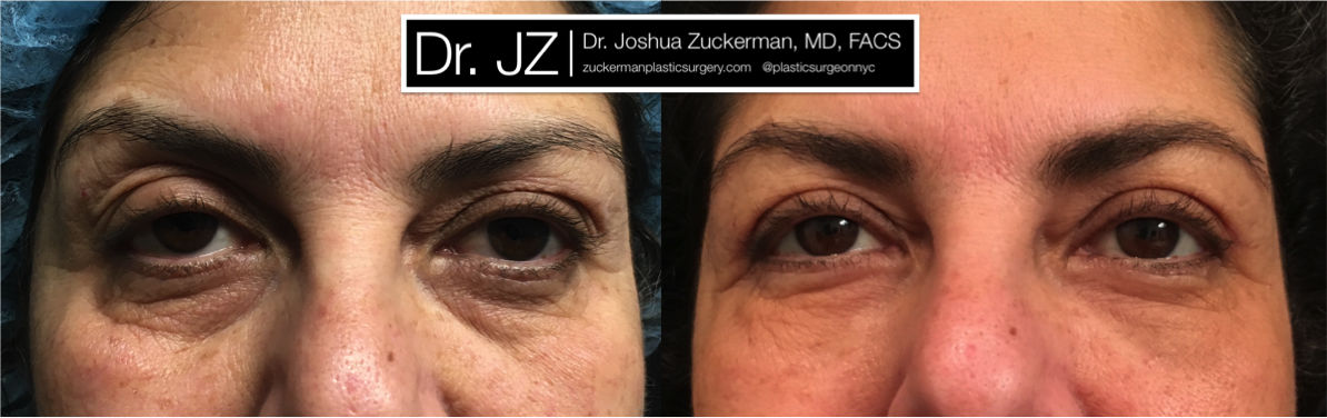 Eyelid surgery (blepharoplasty ) by Dr. Zuckerman. Patient, female, 1 month postop. Also performed fat grafting to the lower eyelids and tear troughs. frontal