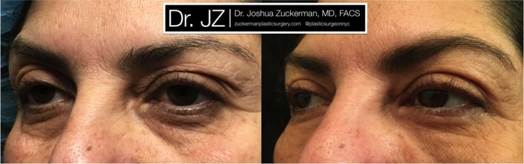 Eyelid surgery (blepharoplasty ) by Dr. Zuckerman. Patient, female, 1 month postop. Also performed fat grafting to the lower eyelids and tear troughs. left oblique