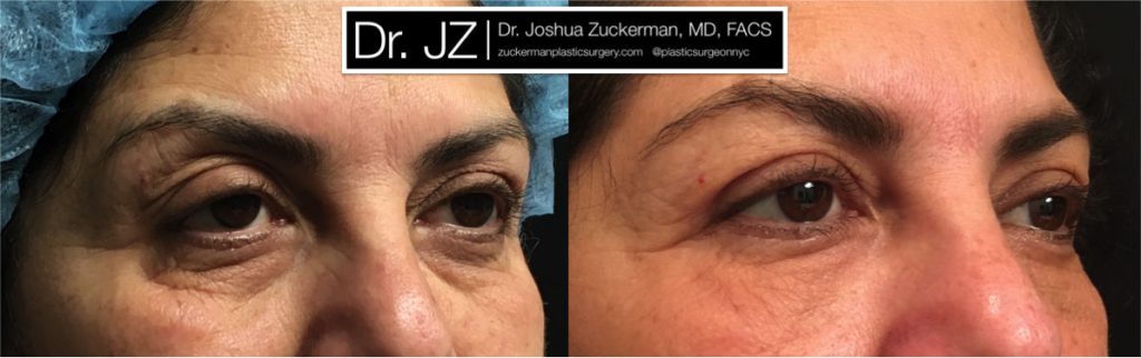 Eyelid surgery (blepharoplasty ) by Dr. Zuckerman. Patient, female, 1 month postop. Also performed fat grafting to the lower eyelids and tear troughs. right oblique