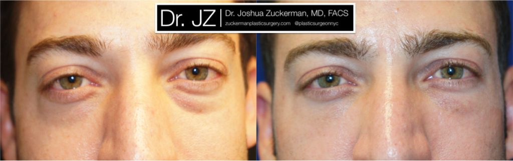 Eyelid surgery (blepharoplasty) by Dr. Zuckerman. Patient, male, 1.5 months postop. Lower eyelid blepharoplasty with fat grafting to tear troughs. frontal