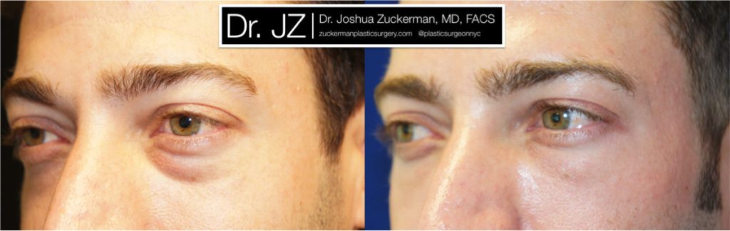 Eyelid surgery (blepharoplasty) by Dr. Zuckerman. Patient, male, 1.5 months postop. Lower eyelid blepharoplasty with fat grafting to tear troughs. left oblique