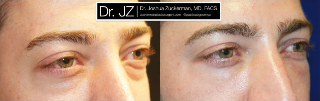 Eyelid surgery (blepharoplasty) by Dr. Zuckerman. Patient, male, 1.5 months postop. Lower eyelid blepharoplasty with fat grafting to tear troughs. right oblique