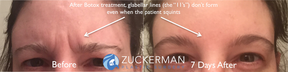 botox cosmetic featured before and after 2 glabellar lines 11s 1883x296 1 Botox treatment to the glabella muscles by Dr. Zuckerman at Zuckerman Plastic Surgery in Manhattan. The patient will not form vertical lines between the eybrows even when squinting. Patient pictured before and seven days after treatment.