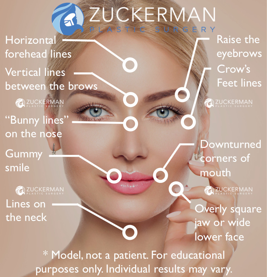 botox possible treatment areas forehead crows feet eyebrow lift bunny lines nose downturned mouth neck square jaw botox possible treatment areas forehead crows feet eyebrow lift bunny lines nose downturned mouth neck square jaw