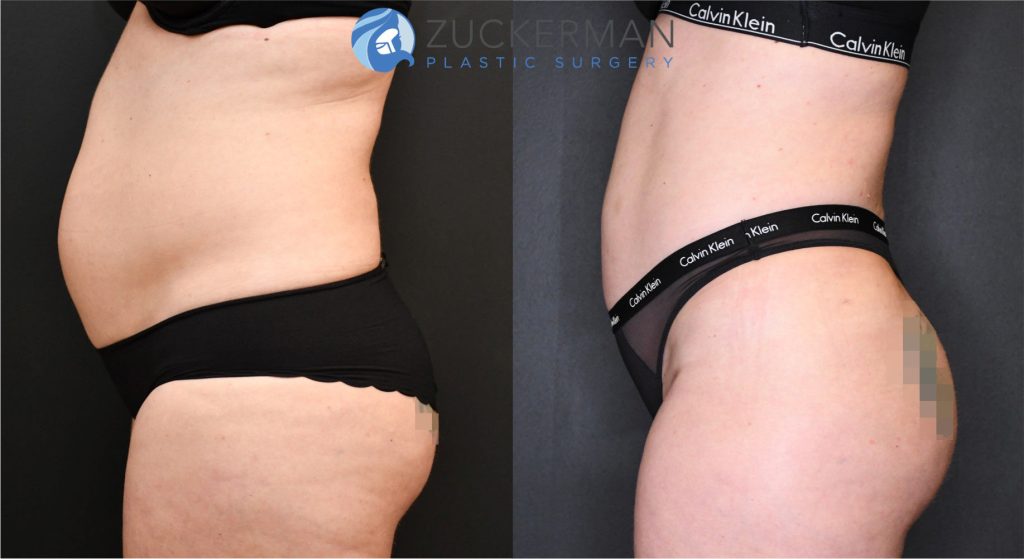 Buttock augmentation, or Brazilian Butt Lift (BBL), by Dr. Zuckerman. Patient, female, 3 months postop. Approximately 2.5 liters of fat removed from abdomen, flanks, and lower back. Approximately 700cc of fat grafted to each buttock. left profile2