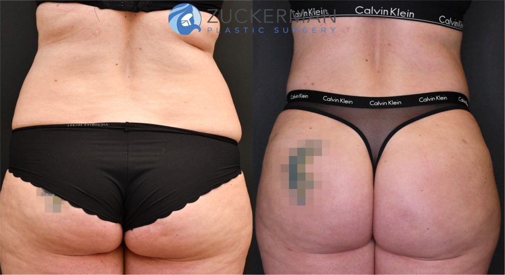 Buttock augmentation, or Brazilian Butt Lift (BBL), by Dr. Zuckerman. Patient, female, 3 months postop. Approximately 2.5 liters of fat removed from abdomen, flanks, and lower back. Approximately 700cc of fat grafted to each buttock. posterior