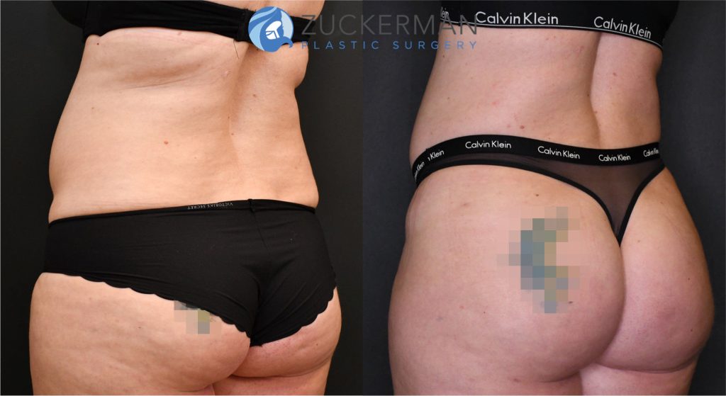 Buttock augmentation, or Brazilian Butt Lift (BBL), by Dr. Zuckerman. Patient, female, 3 months postop. Approximately 2.5 liters of fat removed from abdomen, flanks, and lower back. Approximately 700cc of fat grafted to each buttock. posterior left oblique