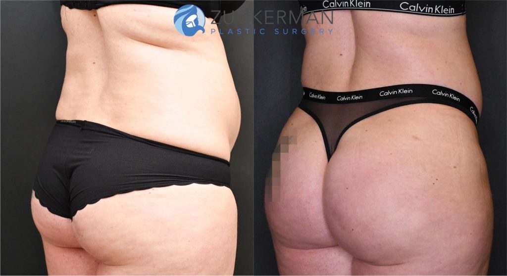 Buttock augmentation, or Brazilian Butt Lift (BBL), by Dr. Zuckerman. Patient, female, 3 months postop. Approximately 2.5 liters of fat removed from abdomen, flanks, and lower back. Approximately 700cc of fat grafted to each buttock. posterior right oblique