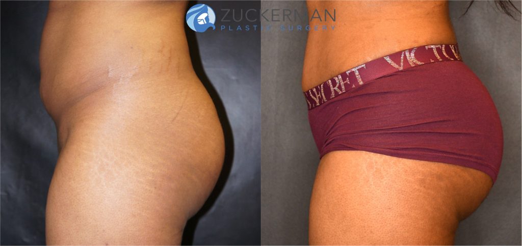 Buttock augmentation, or Brazilian Butt Lift (BBL), by Dr. Zuckerman. Patient, female, 6 months postop. Fat harvested from abdomen, flanks, and lower back and from tissue removed via abdominoplasty. Approximately 650cc of fat grafted to each buttock. Abdominoplasty also performed. left profile