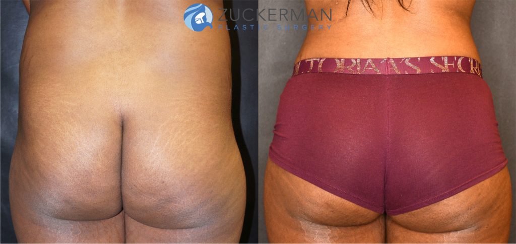 Buttock augmentation, or Brazilian Butt Lift (BBL), by Dr. Zuckerman. Patient, female, 6 months postop. Fat harvested from abdomen, flanks, and lower back and from tissue removed via abdominoplasty. Approximately 650cc of fat grafted to each buttock. Abdominoplasty also performed. posterior