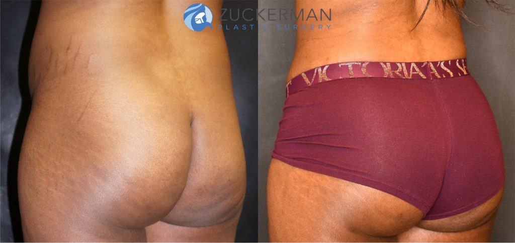 Buttock augmentation, or Brazilian Butt Lift (BBL), by Dr. Zuckerman. Patient, female, 6 months postop. Fat harvested from abdomen, flanks, and lower back and from tissue removed via abdominoplasty. Approximately 650cc of fat grafted to each buttock. Abdominoplasty also performed. posterior left oblique