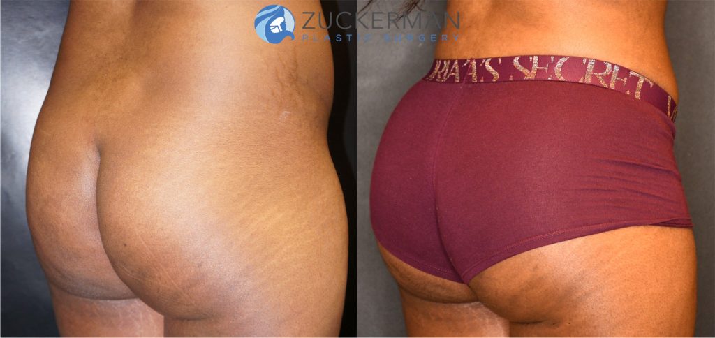 Buttock augmentation, or Brazilian Butt Lift (BBL), by Dr. Zuckerman. Patient, female, 6 months postop. Fat harvested from abdomen, flanks, and lower back and from tissue removed via abdominoplasty. Approximately 650cc of fat grafted to each buttock. Abdominoplasty also performed. posterior right oblique