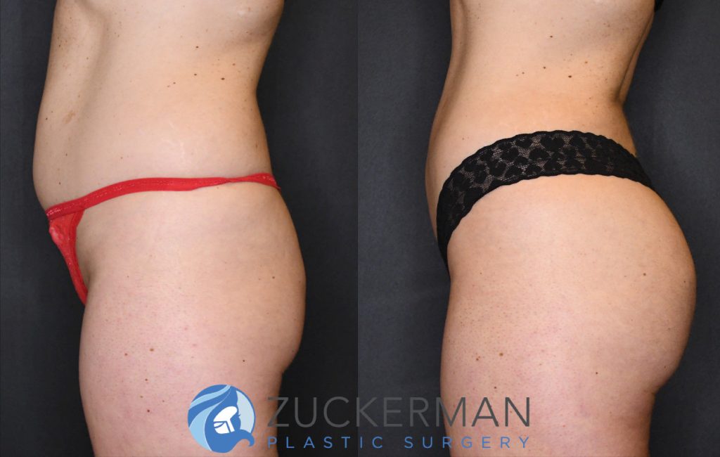 Buttock augmentation, or Brazilian Butt Lift (BBL), by Dr. Zuckerman. Patient, female, 3 months postop. 3 liters of fat removed from abdomen, flanks, and lower back. 875cc of fat grafted to each buttock. left profile