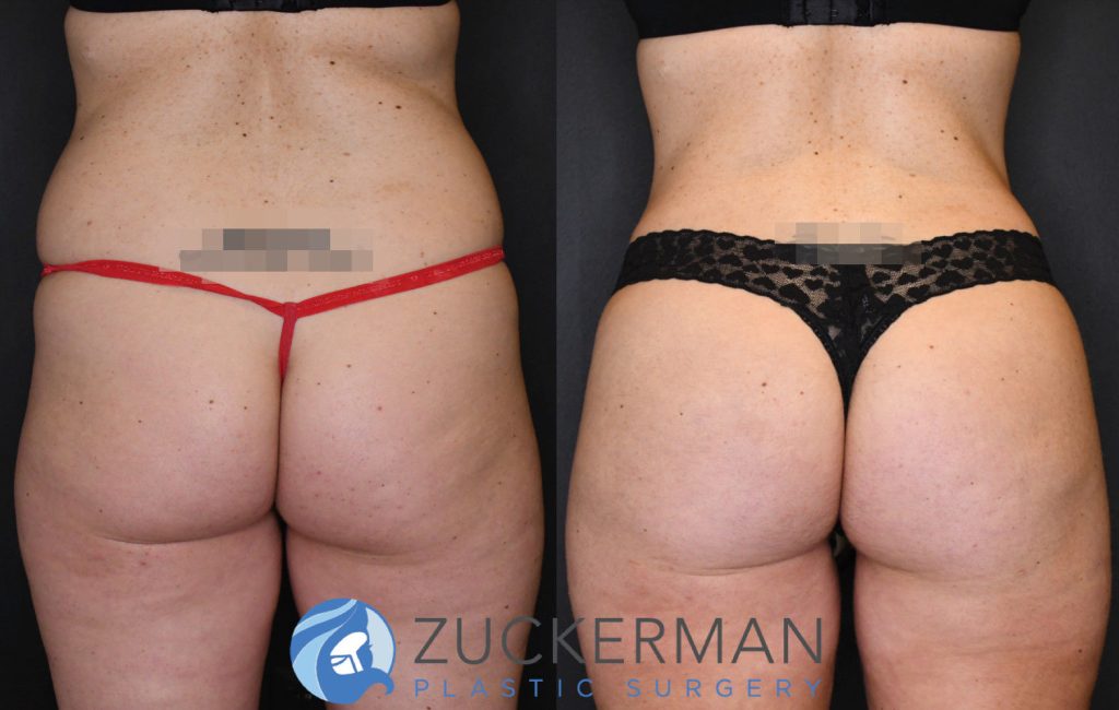 Buttock augmentation, or Brazilian Butt Lift (BBL), by Dr. Zuckerman. Patient, female, 3 months postop. 3 liters of fat removed from abdomen, flanks, and lower back. 875cc of fat grafted to each buttock. posterior