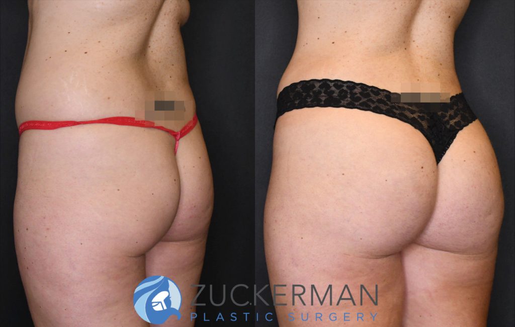 Buttock augmentation, or Brazilian Butt Lift (BBL), by Dr. Zuckerman. Patient, female, 3 months postop. 3 liters of fat removed from abdomen, flanks, and lower back. 875cc of fat grafted to each buttock. posterior left oblique