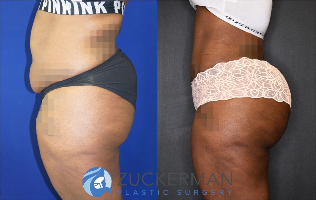 Buttock augmentation, or Brazilian Butt Lift (BBL), by Dr. Zuckerman. Patient, female, 12 months postop. 4 liters of fat removed from abdomen, flanks, and lower back. 1350cc of fat grafted to each buttock. Patient desired a large, dramatic augmentation. Abdominoplasty also performed. Some after images were brightened by 15%. left profile