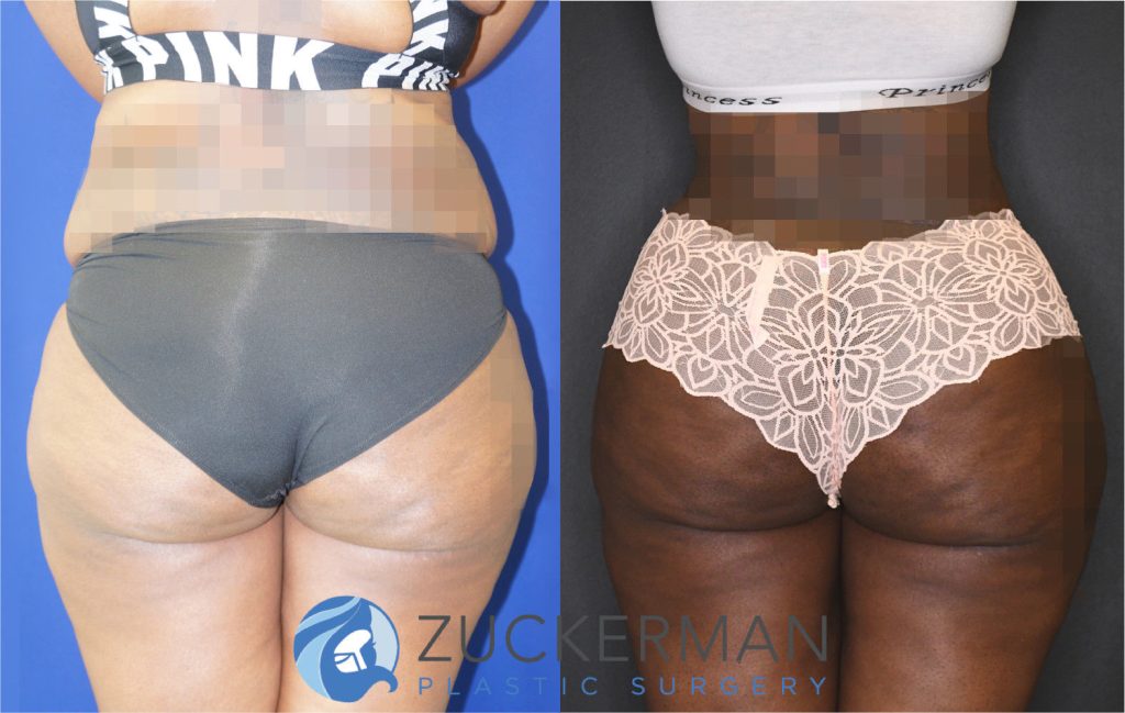 Buttock augmentation, or Brazilian Butt Lift (BBL), by Dr. Zuckerman. Patient, female, 12 months postop. 4 liters of fat removed from abdomen, flanks, and lower back. 1350cc of fat grafted to each buttock. Patient desired a large, dramatic augmentation. Abdominoplasty also performed. Some after images were brightened by 15%. posterior