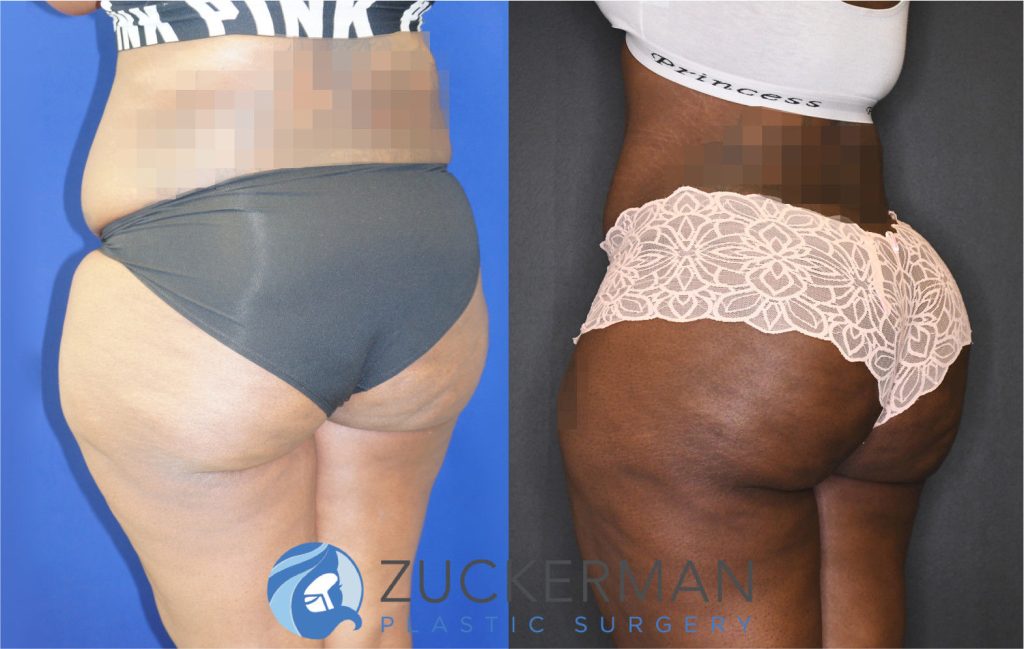 Buttock augmentation, or Brazilian Butt Lift (BBL), by Dr. Zuckerman. Patient, female, 12 months postop. 4 liters of fat removed from abdomen, flanks, and lower back. 1350cc of fat grafted to each buttock. Patient desired a large, dramatic augmentation. Abdominoplasty also performed. Some after images were brightened by 15%. posterior left oblique