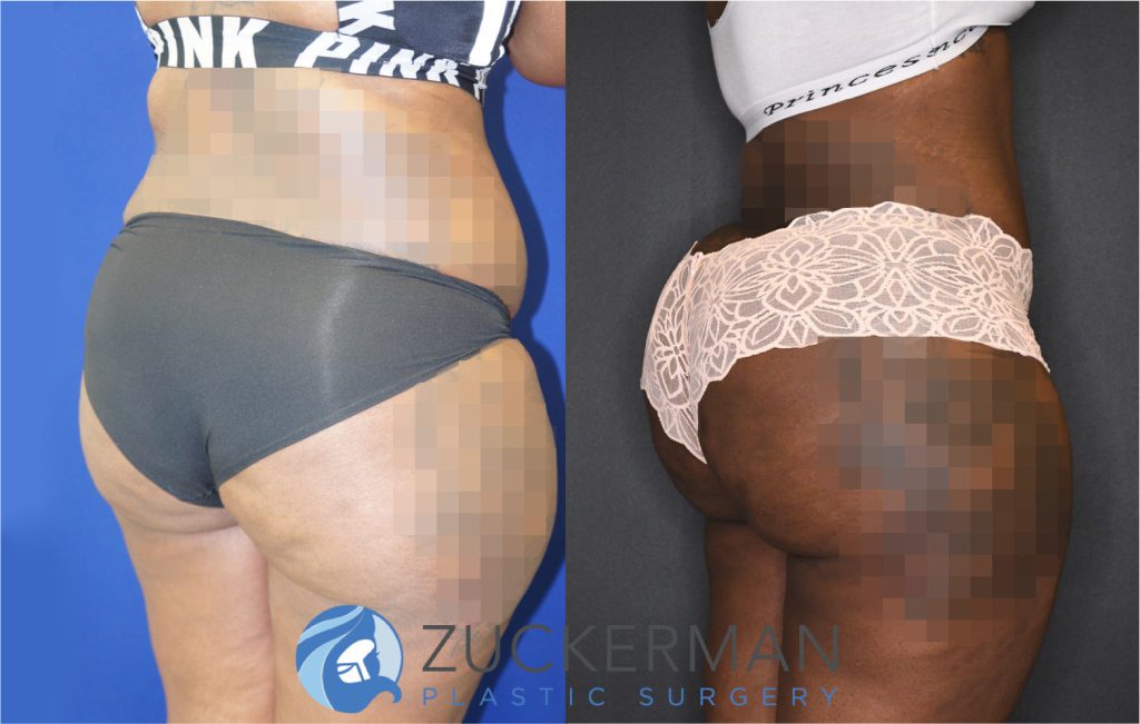 Buttock augmentation, or Brazilian Butt Lift (BBL), by Dr. Zuckerman. Patient, female, 12 months postop. 4 liters of fat removed from abdomen, flanks, and lower back. 1350cc of fat grafted to each buttock. Patient desired a large, dramatic augmentation. Abdominoplasty also performed. Some after images were brightened by 15%. posterior right oblique