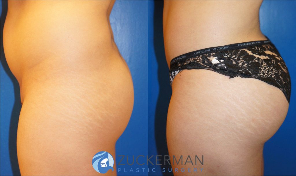 Buttock augmentation, or Brazilian Butt Lift (BBL), by Dr. Zuckerman. Patient, female, 2 months postop. 2 liters of fat removed from abdomen, flanks, and lower back. 560cc of fat grafted to each buttock. left profile