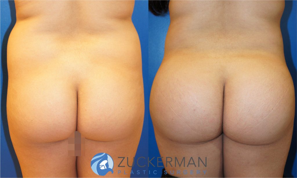 Buttock augmentation, or Brazilian Butt Lift (BBL), by Dr. Zuckerman. Patient, female, 2 months postop. 2 liters of fat removed from abdomen, flanks, and lower back. 560cc of fat grafted to each buttock. posterior