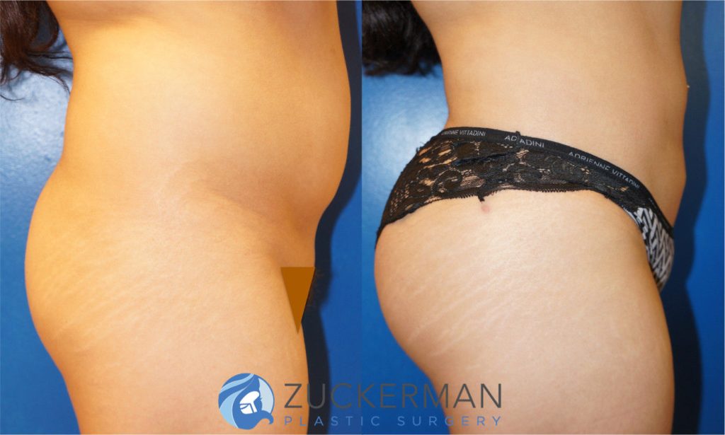 Buttock augmentation, or Brazilian Butt Lift (BBL), by Dr. Zuckerman. Patient, female, 2 months postop. 2 liters of fat removed from abdomen, flanks, and lower back. 560cc of fat grafted to each buttock. right profile