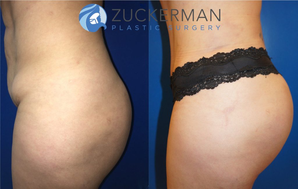 Buttock augmentation, or Brazilian Butt Lift (BBL), by Dr. Zuckerman. Patient, female, 1.5 months postop. 2 liters of fat removed from abdomen, flanks, and lower back. 600cc of fat grafted to each buttock. Revision tummy tuck (abdominoplasty) also performed. left profile