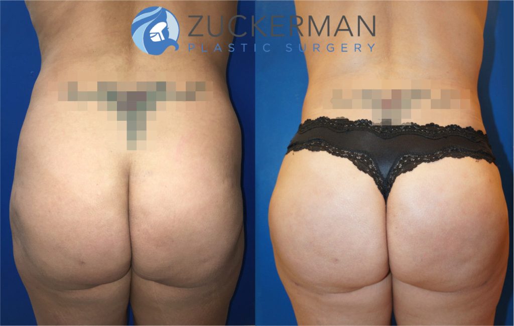 Buttock augmentation, or Brazilian Butt Lift (BBL), by Dr. Zuckerman. Patient, female, 1.5 months postop. 2 liters of fat removed from abdomen, flanks, and lower back. 600cc of fat grafted to each buttock. Revision tummy tuck (abdominoplasty) also performed. posterior