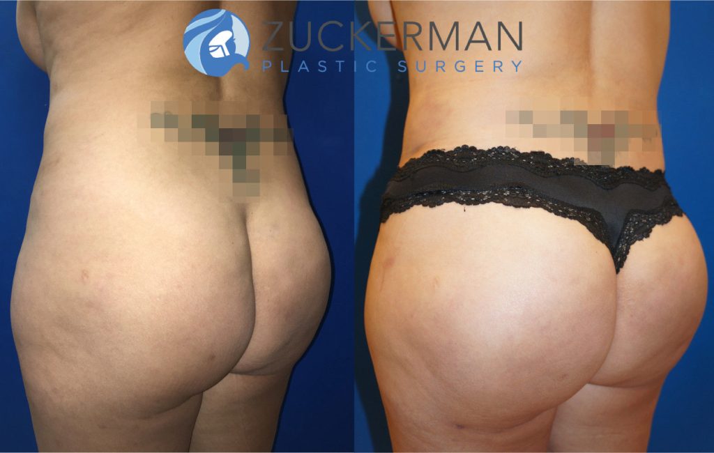 Buttock augmentation, or Brazilian Butt Lift (BBL), by Dr. Zuckerman. Patient, female, 1.5 months postop. 2 liters of fat removed from abdomen, flanks, and lower back. 600cc of fat grafted to each buttock. Revision tummy tuck (abdominoplasty) also performed. posterior left oblique