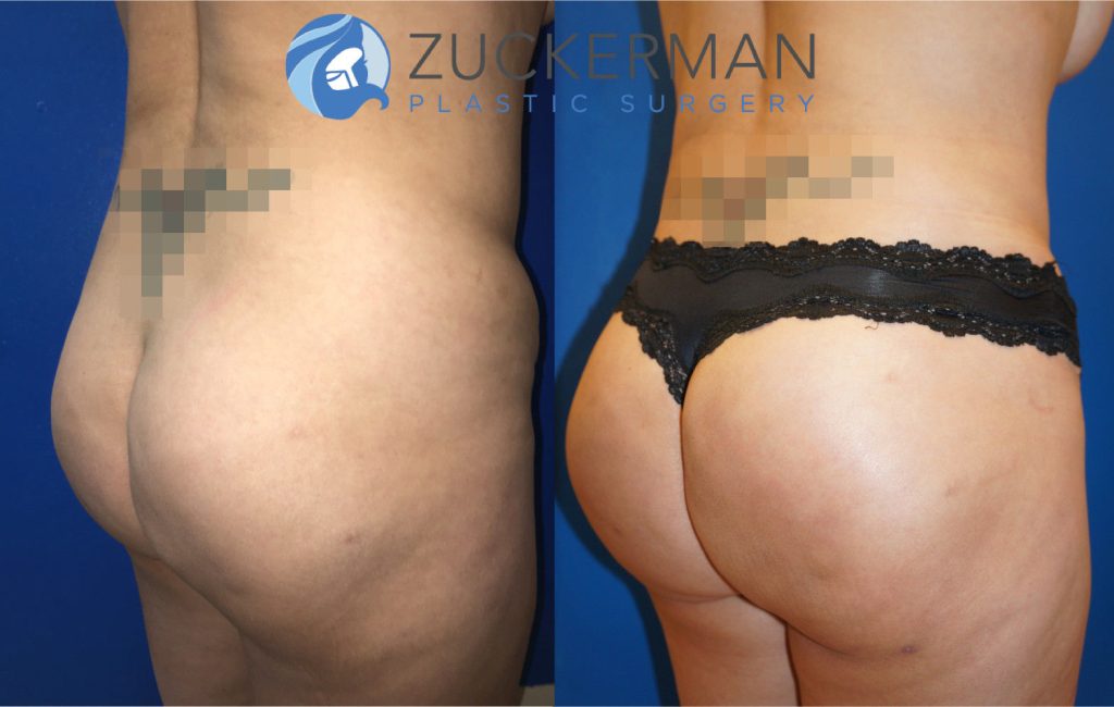 Buttock augmentation, or Brazilian Butt Lift (BBL), by Dr. Zuckerman. Patient, female, 1.5 months postop. 2 liters of fat removed from abdomen, flanks, and lower back. 600cc of fat grafted to each buttock. Revision tummy tuck (abdominoplasty) also performed. posterior right oblique