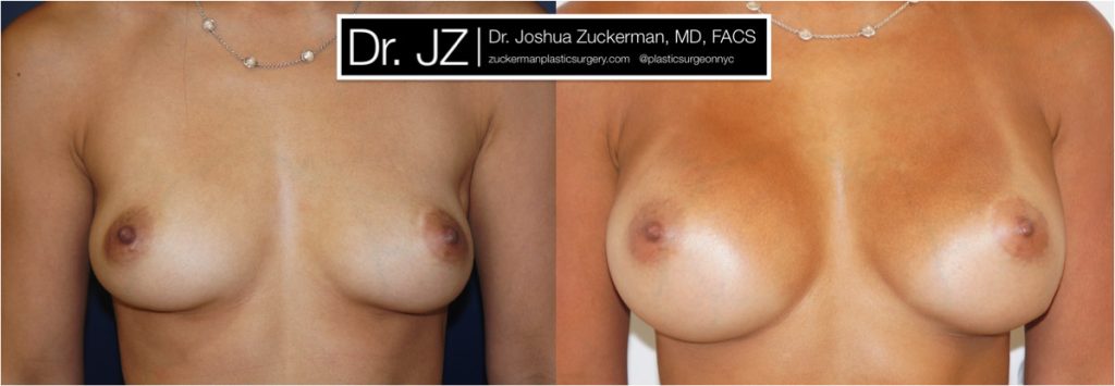 Breast augmentation by Dr. Zuckerman. Patient, female