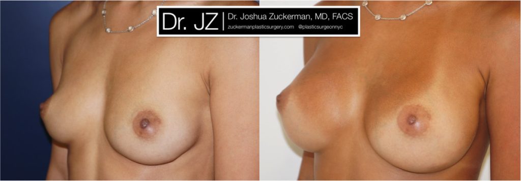 Breast augmentation by Dr. Zuckerman. Patient, female