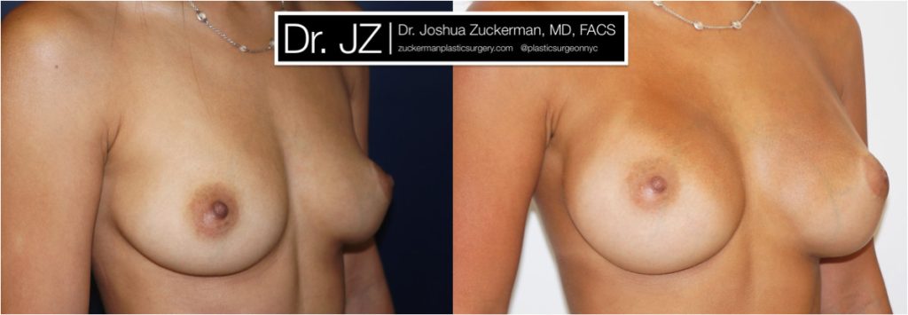 Breast augmentation by Dr. Zuckerman. Patient, female