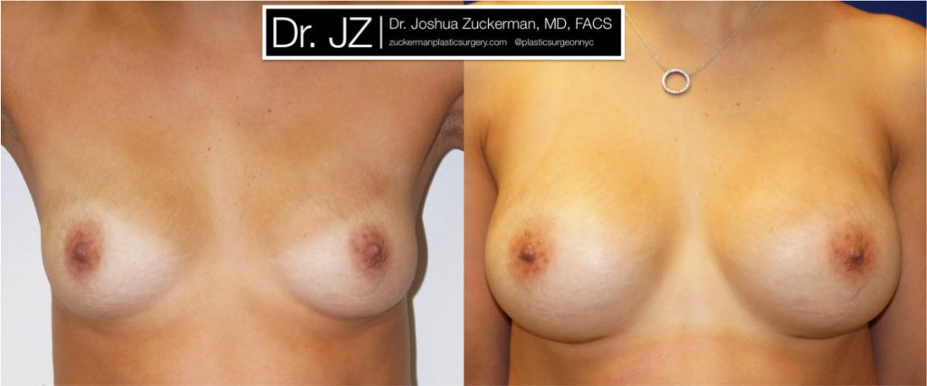 Breast augmentation by Dr. Zuckerman. Patient, female, frontal