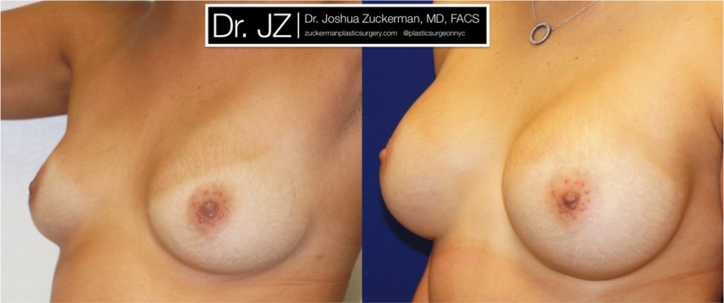 Breast augmentation by Dr. Zuckerman. Patient, female, left oblique