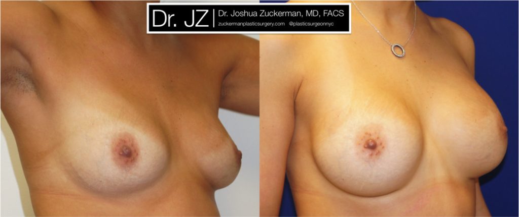 Breast augmentation by Dr. Zuckerman. Patient, female, right oblique