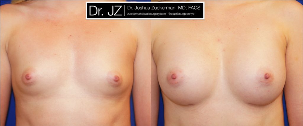 Breast augmentation by Dr. Zuckerman. Patient, female, 2 months postop. 275cc Mentor Smooth Round High Profile breast implants. frontal