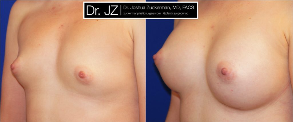 Breast augmentation by Dr. Zuckerman. Patient, female, 2 months postop. 275cc Mentor Smooth Round High Profile breast implants. left oblique