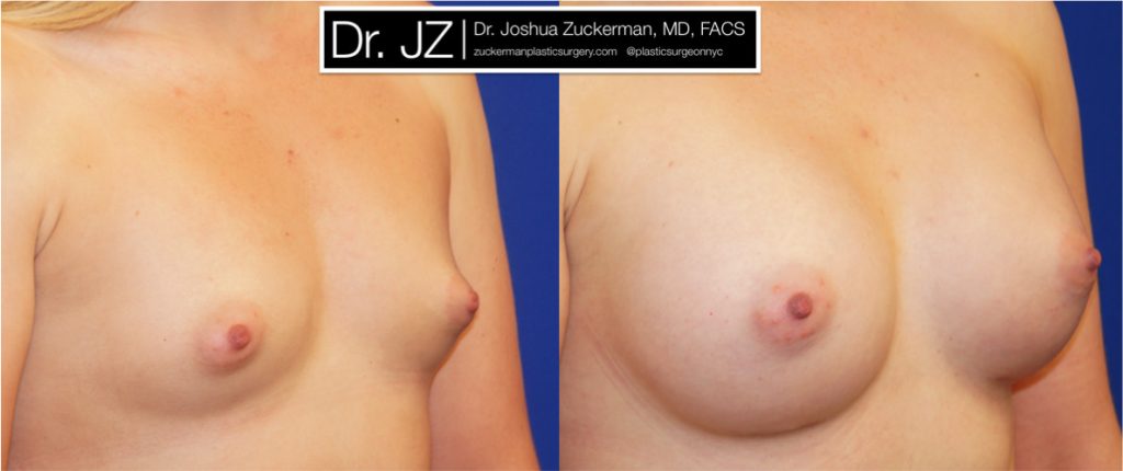 Breast augmentation by Dr. Zuckerman. Patient, female, 2 months postop. 275cc Mentor Smooth Round High Profile breast implants. right oblique