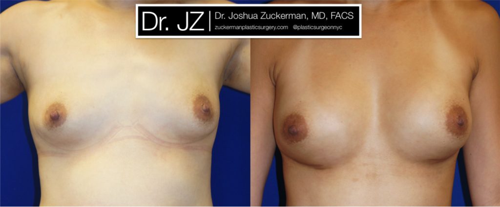 Breast augmentation by Dr. Zuckerman. Patient, female, 1 month postop. 400cc Mentor Smooth Round silicone breast implants, with submuscular placement. frontal