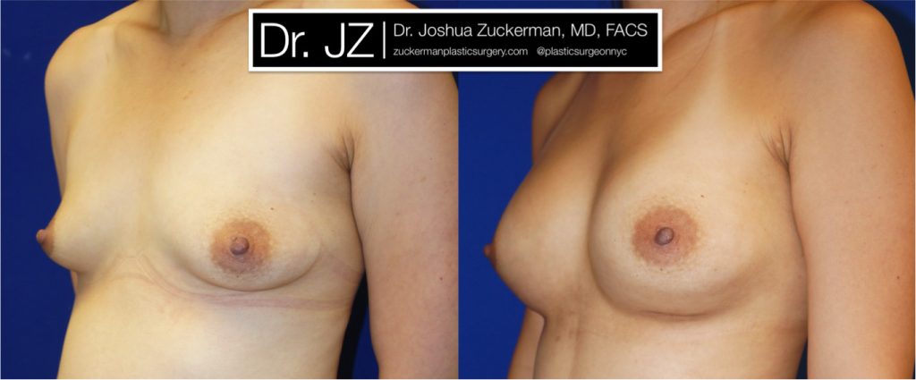 Breast augmentation by Dr. Zuckerman. Patient, female, 1 month postop. 400cc Mentor Smooth Round silicone breast implants, with submuscular placement. left oblique