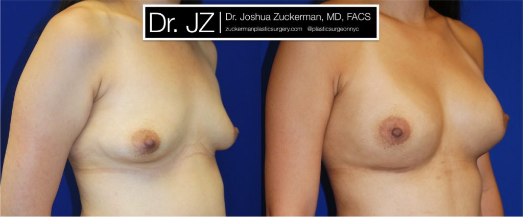 Breast augmentation by Dr. Zuckerman. Patient, female, 1 month postop. 400cc Mentor Smooth Round silicone breast implants, with submuscular placement. right oblique