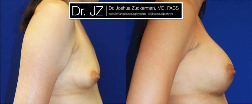 Breast augmentation by Dr. Zuckerman. Patient, female, 1 month postop. 400cc Mentor Smooth Round silicone breast implants, with submuscular placement. right profile