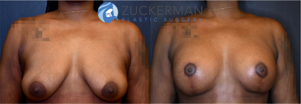 Breast augmentation by Dr. Zuckerman. Patient, female, 2 months postop. 275cc smooth round silicone breast implants, with submuscular placement. Combined mastopexy. frontal