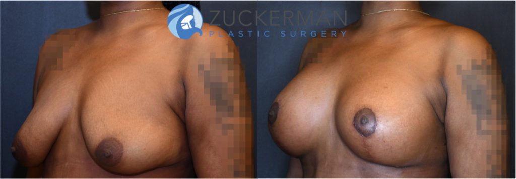 Breast augmentation by Dr. Zuckerman. Patient, female, 2 months postop. 275cc smooth round silicone breast implants, with submuscular placement. Combined mastopexy.left oblique