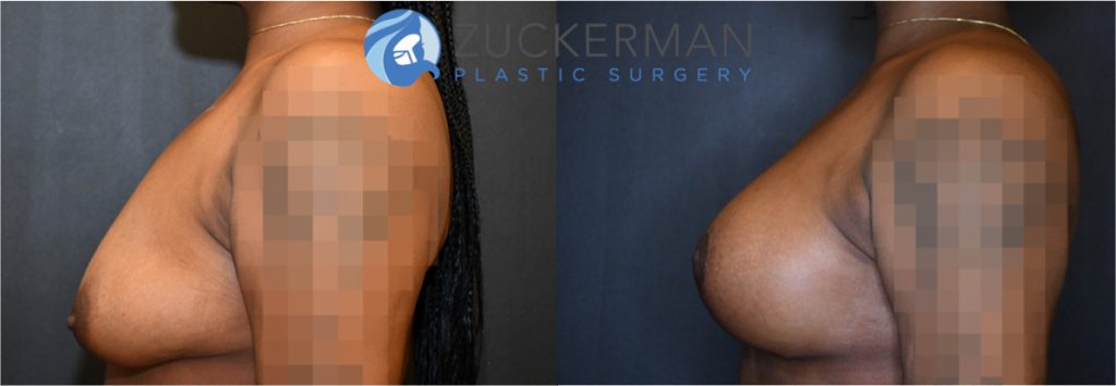 Breast augmentation by Dr. Zuckerman. Patient, female, 2 months postop. 275cc smooth round silicone breast implants, with submuscular placement. Combined mastopexy. left profile