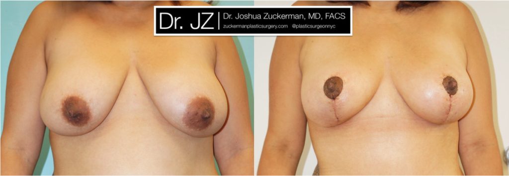 Breast lift (mastopexy) by Dr. Zuckerman. Patient, female, 2 months postop. Vertical breast lift. frontal