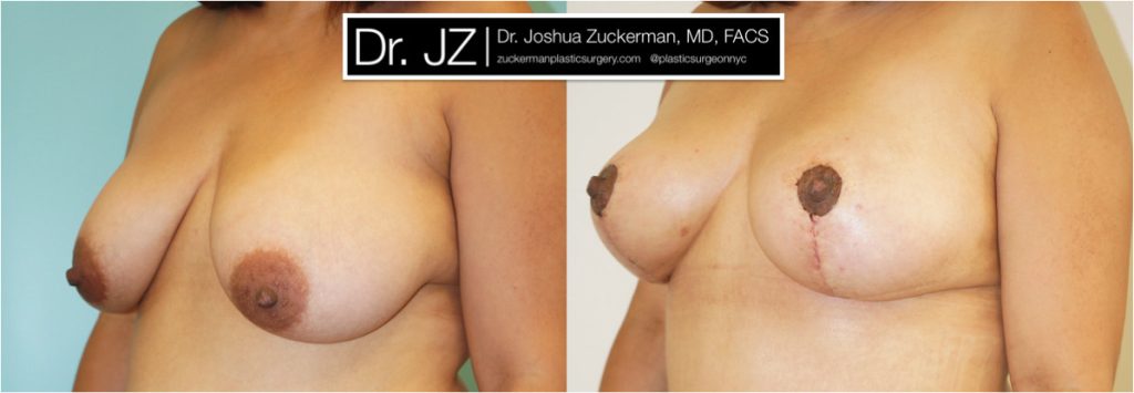 Breast lift (mastopexy) by Dr. Zuckerman. Patient, female, 2 months postop. Vertical breast lift. left oblique