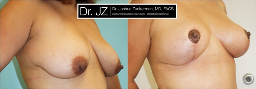 Breast lift (mastopexy) by Dr. Zuckerman. Patient, female, 2 months postop. Vertical breast lift. right oblique